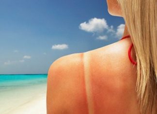 how to get rid of sunburn