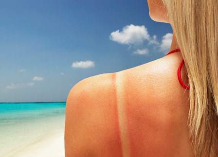 how to get rid of sunburn fast