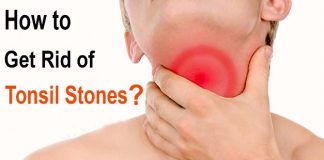 how to get rid of tonsil stones