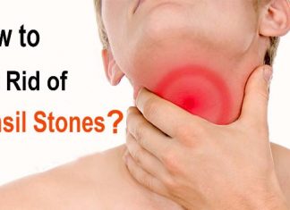 how to get rid of tonsil stones