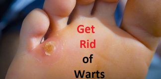 how to get rid of warts