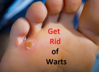 how to get rid of warts