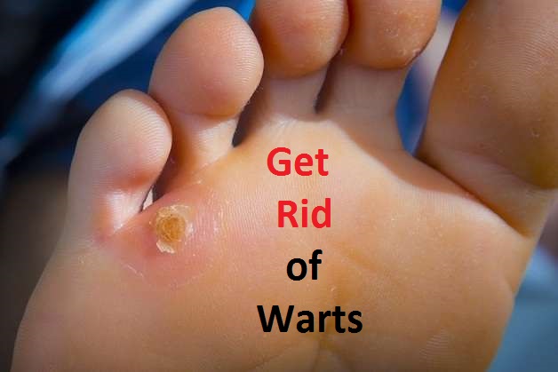 how to get rid of warts