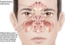 how to relieve sinus pressure