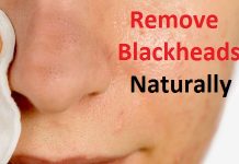 how to remove blackheads