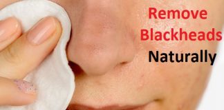 how to remove blackheads