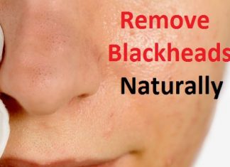 how to remove blackheads