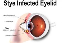 how to treat a stye