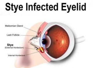 how to treat a stye