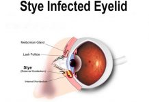 how to treat a stye