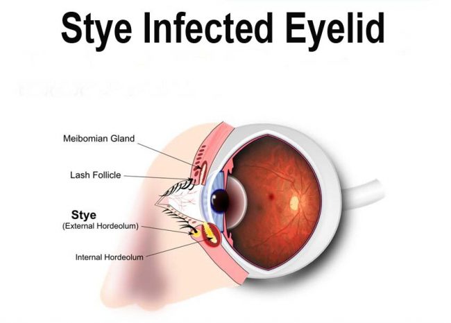 how to treat a stye