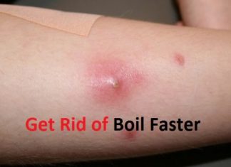 how to get rid of a boil