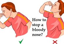 How to Stop a Bloody Nose