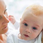 how to get rid of cradle cap