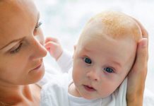 how to get rid of cradle cap