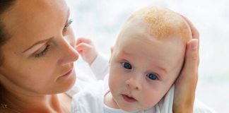 how to get rid of cradle cap