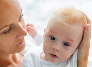 how to get rid of cradle cap