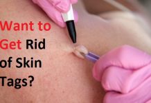 get rid of skin tags