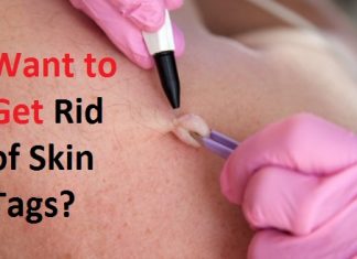 get rid of skin tags