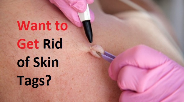 get rid of skin tags