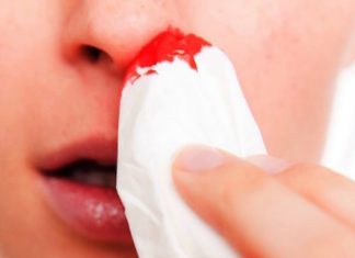 how to stop nose bleeding