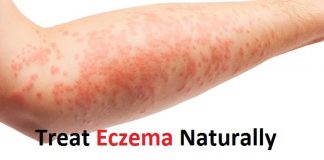 How to Treat Eczema Naturally