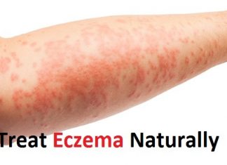 How to Treat Eczema Naturally