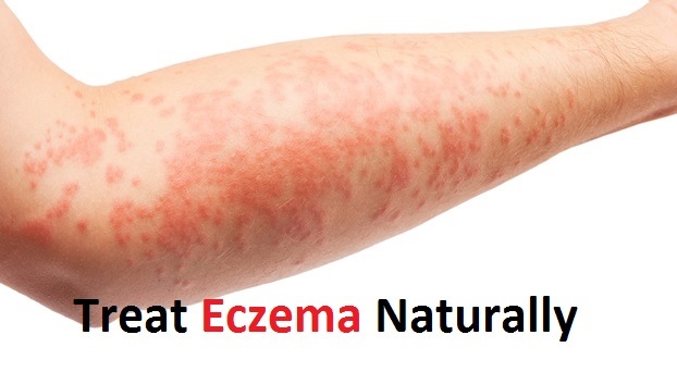 How to Treat Eczema Naturally