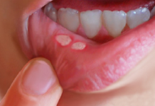 How to get rid of canker sore