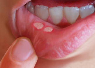 How to get rid of canker sore