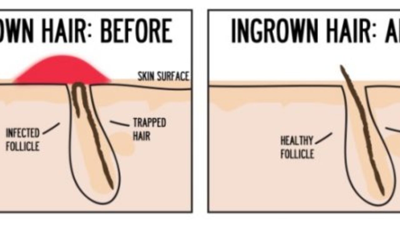 How To Get Rid Of Ingrown Hair