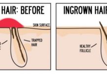 How to get rid of ingrown hair