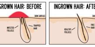 How to get rid of ingrown hair