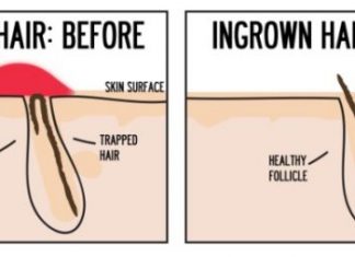 How to get rid of ingrown hair