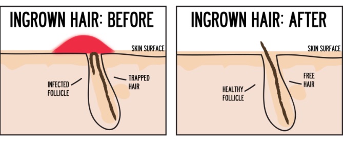 How to get rid of ingrown hair