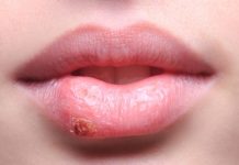 home remedies for cold sores