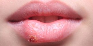 home remedies for cold sores