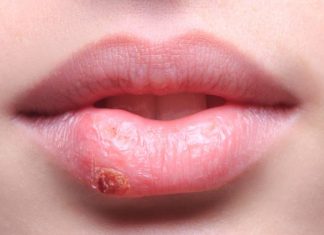 home remedies for cold sores