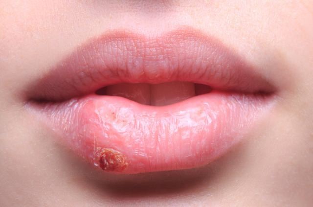 Home Remedies For Cold Sores 