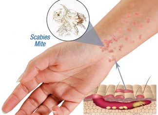 how do you get scabies