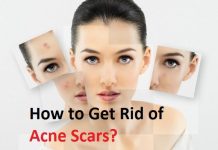 how to get rid of acne scars