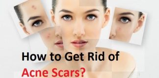 how to get rid of acne scars