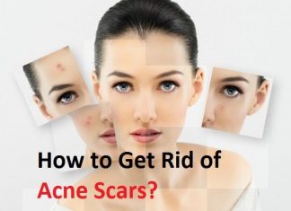 how to get rid of acne scars