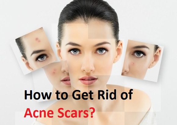 how to get rid of acne scars