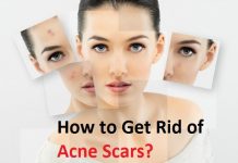 how to get rid of acne scars