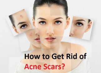 how to get rid of acne scars