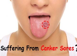 how to get rid of canker sores