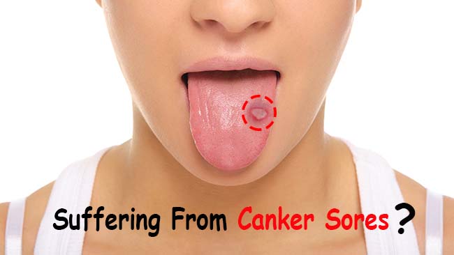 how to get rid of canker sores