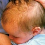 how-to-get-rid-of-cradle-cap