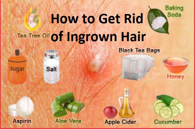 how-to-get-rid-of-ingrown-hair